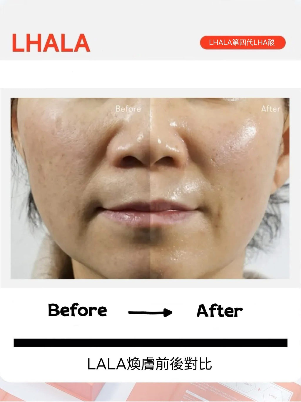 LHA LALA Peel 韓國醫美級煥膚療程第四代果酸煥膚